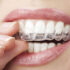 چطور از مینای دندان محافظت کنیم؟