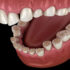 دندان قروچه (بروکسیم) چیست؟